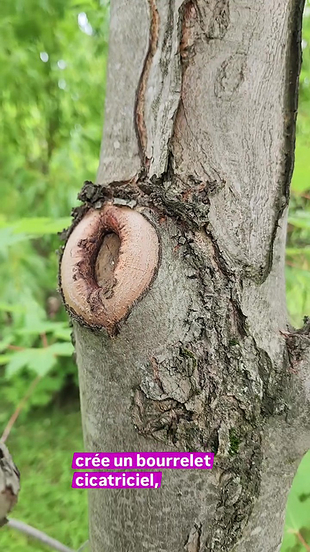 Bourrelet cicatriciel
